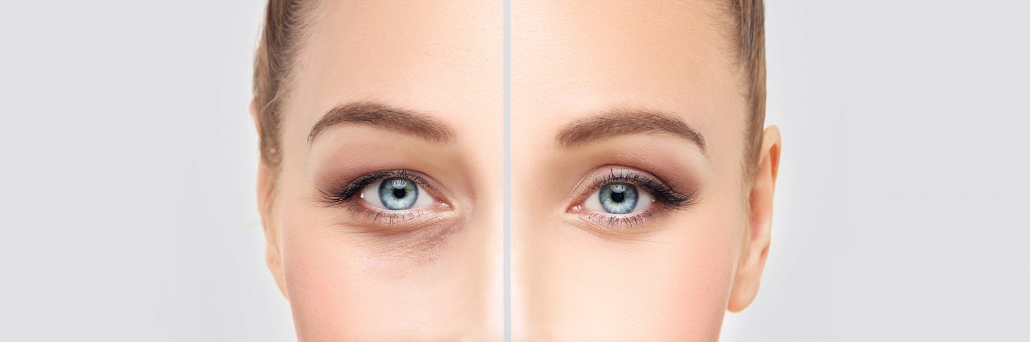 blefaroplastyka shutterstock 502851421 e1506460766640